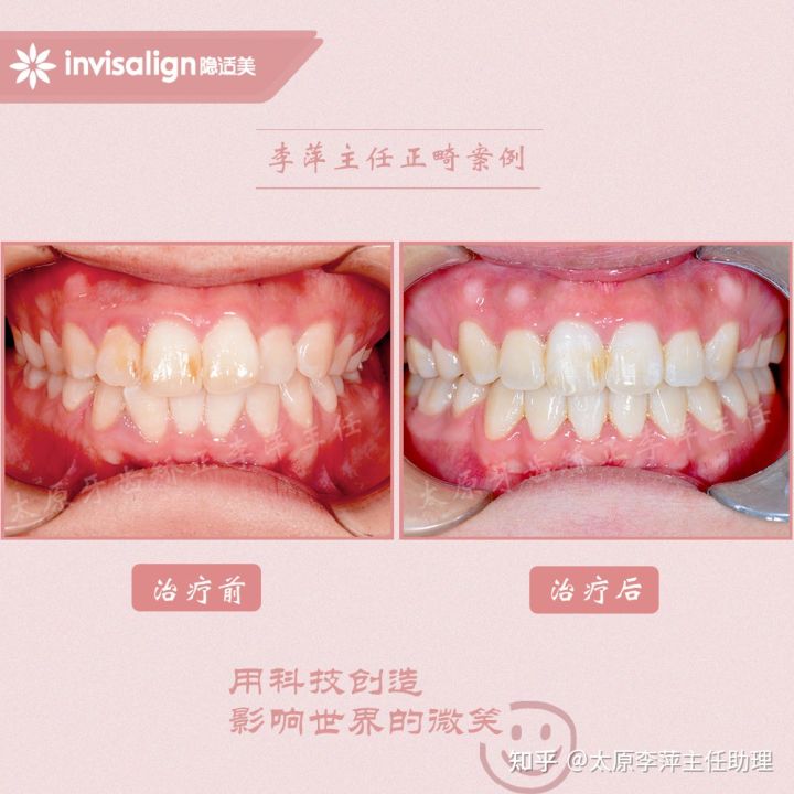 太原整牙齿矫正要多少钱,坏牙齿只剩牙根有必要拔牙吗