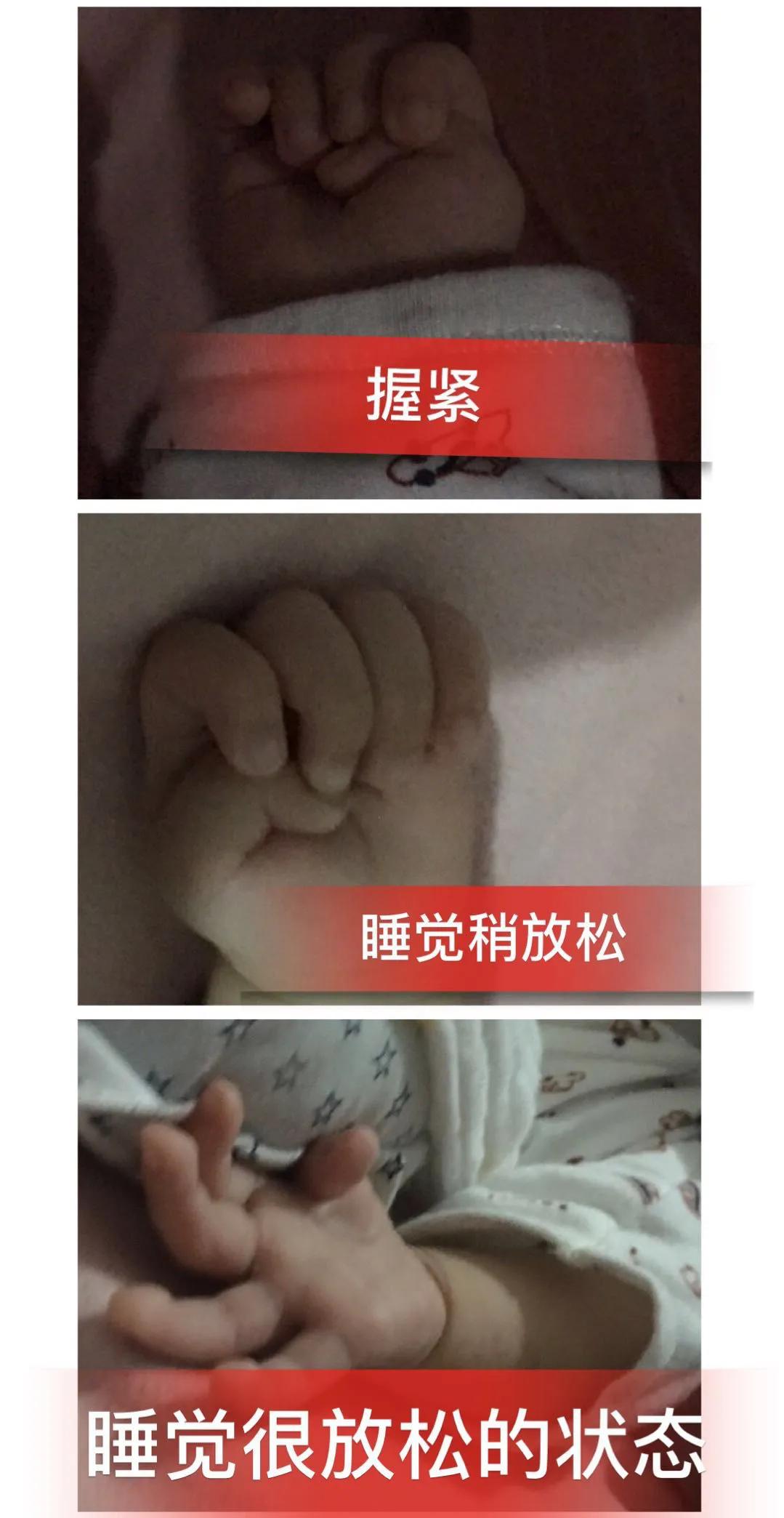 宝宝的手大拇指内弯,宝宝的拇指都是向着掌心的吗