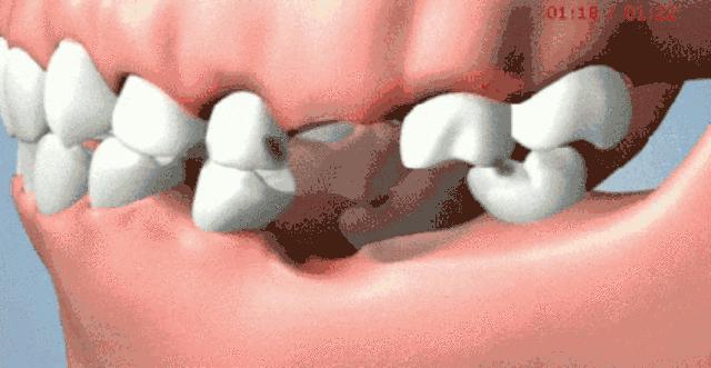 不是我吓你，掉1颗牙不管，周边3颗牙要遭殃