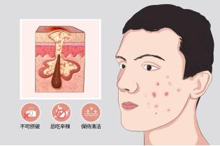 长青春痘怎么办10到13岁女生,长青春痘怎么办10到13岁