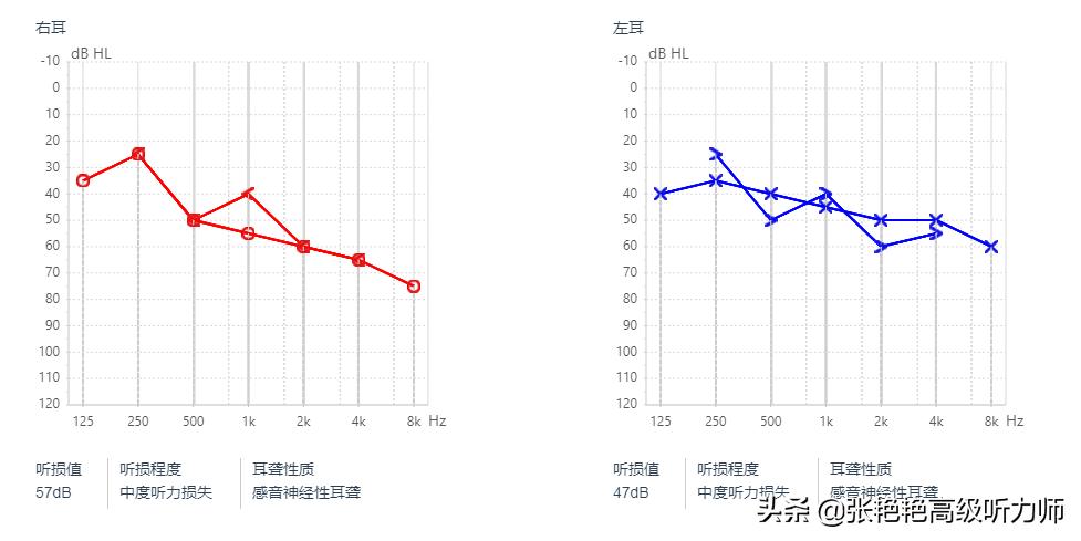 有语言障碍能配助听器吗,说话需要助听器吗