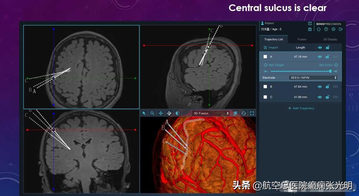 张光明左颞叶癫痫手术成功率,张光明谈治疗癫痫的方法有哪些