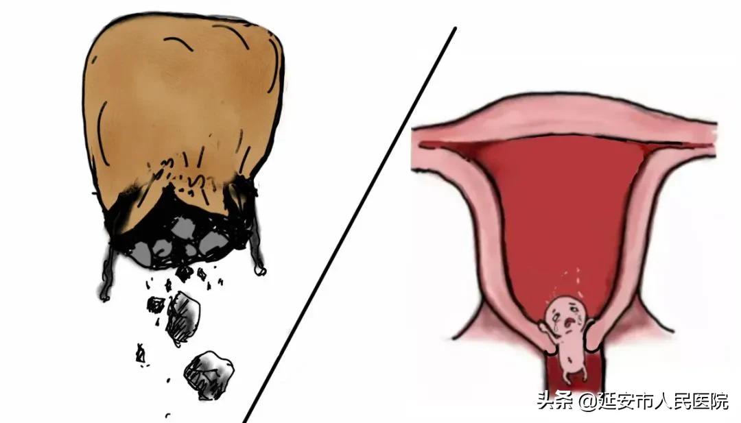 宫颈机能不全患者的福音丨宫颈环扎术
