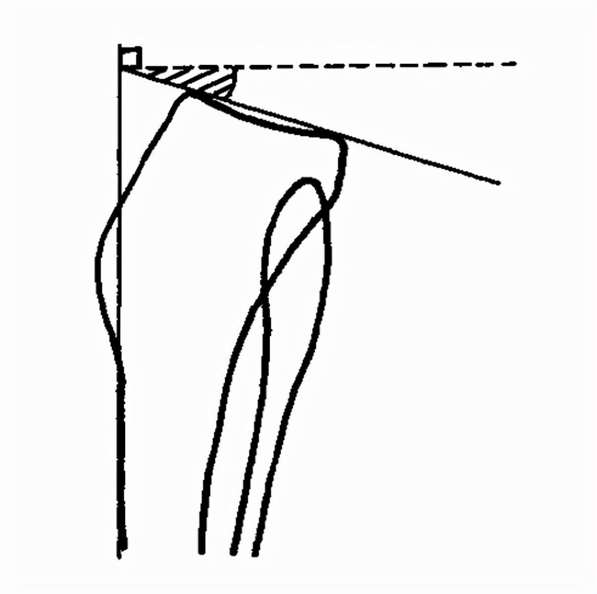 膝关节x线片可以查出啥,膝关节间隙x线测量方法