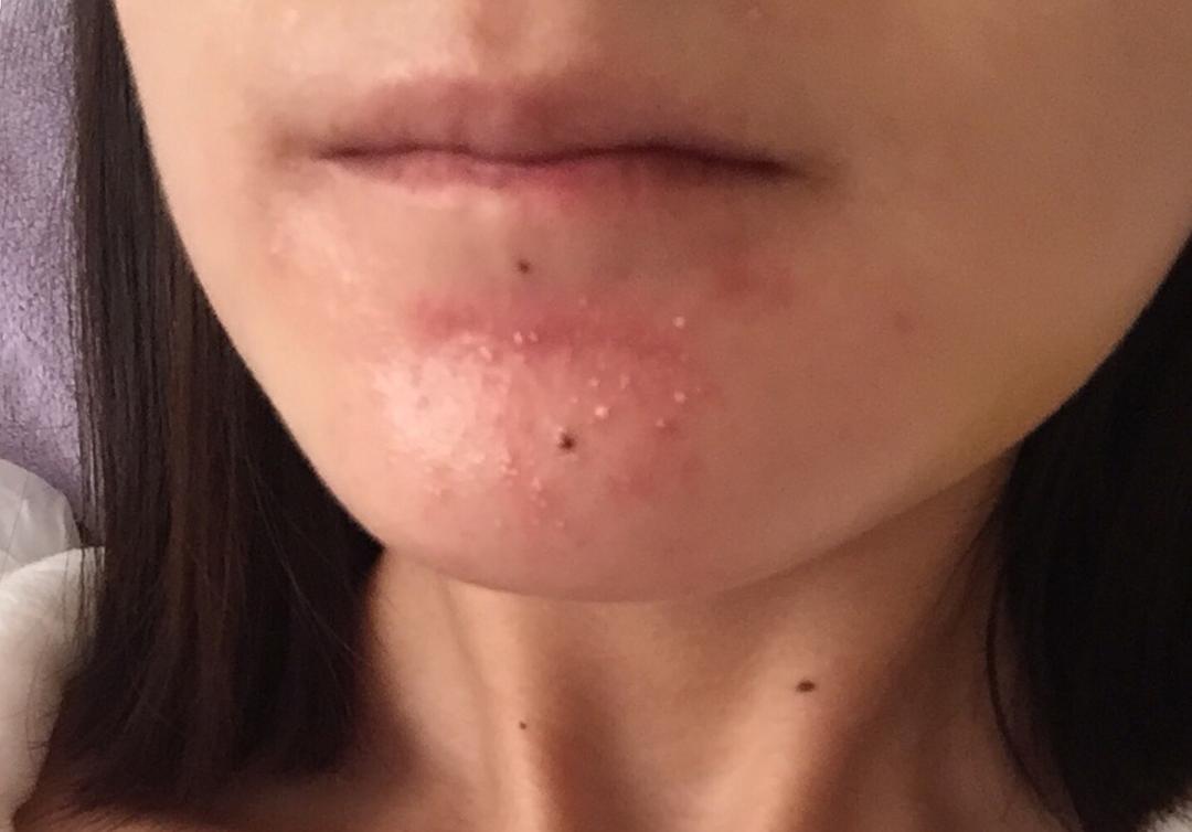 下巴反复长脓包粉刺什么原因,额头和下巴长白头粉刺是什么原因