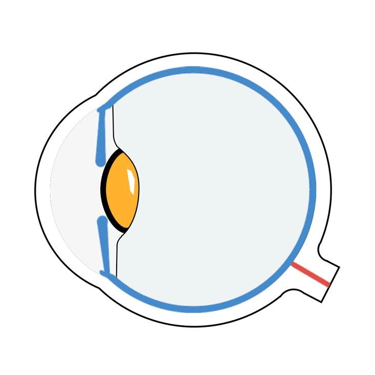 戴眼镜太痛苦，做近视手术需要搞清楚这些