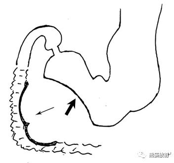 十二指肠球部溃疡解剖位置,十二指肠球部溃疡x线表现