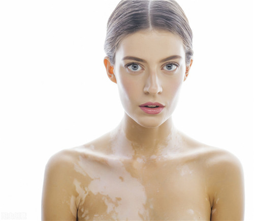 白癜风治愈10大方法,白癜风根本就治不好