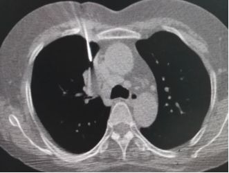 举例科普|介入能治疗哪些疾病?