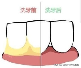 超声波洗牙洁牙是什么,超声波洁牙器洗牙多少钱