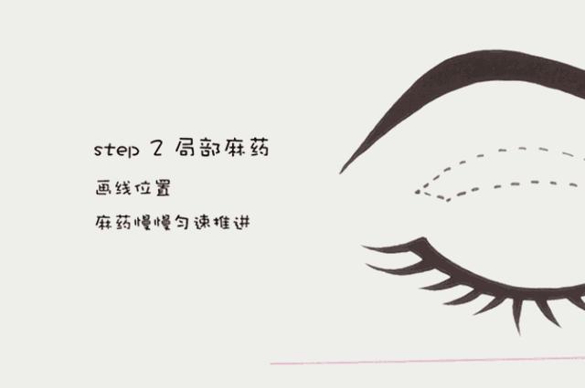 割双眼皮埋线和全切有什么区别,全切双眼皮内眼角割的不一样