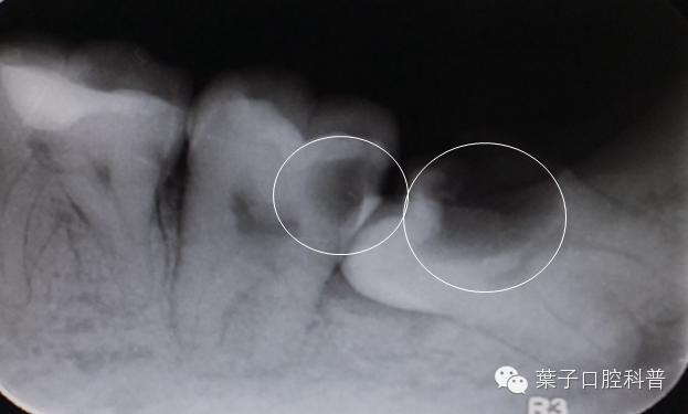 拔智齿：讳疾忌医有什么后果？#葉子口腔科普#