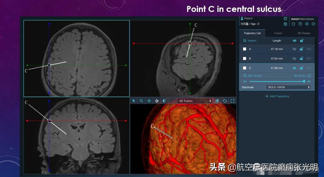 张光明左颞叶癫痫手术成功率,张光明谈治疗癫痫的方法有哪些
