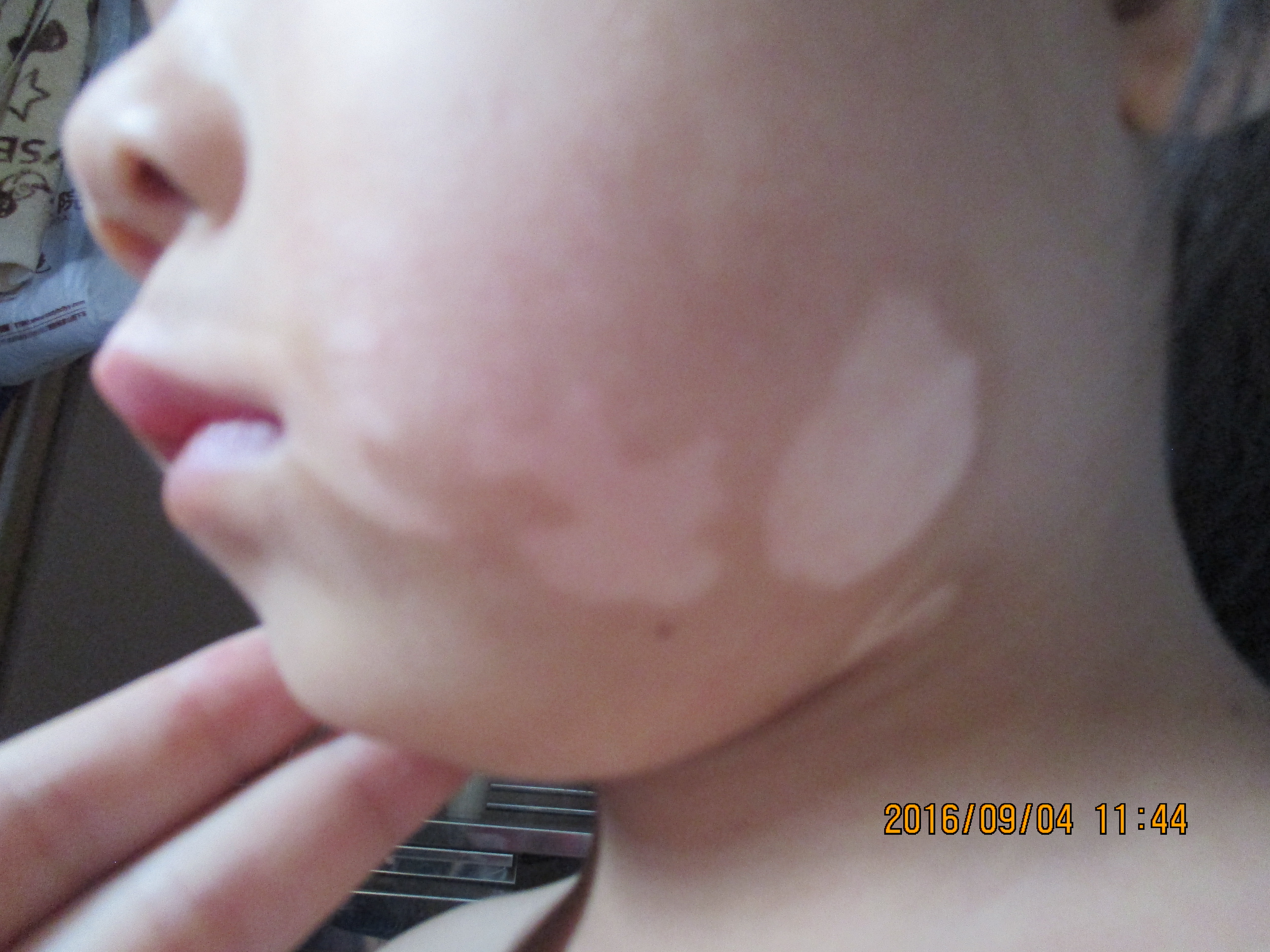 小孩脸上长白斑怎么办,儿童脸部长白斑怎么办