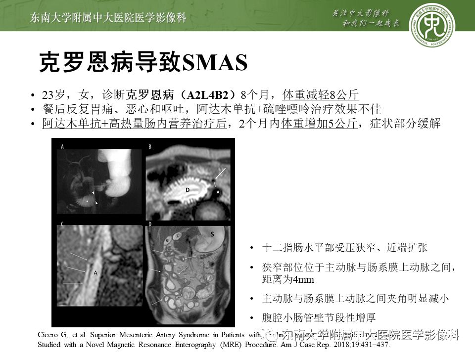 肠系膜上动脉压迫综合征挂什么科,肠系膜上动脉压迫综合征手术费用