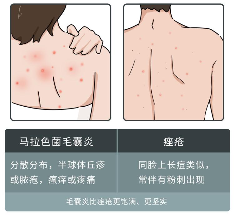 不同部位长痘痘的原因及解决方法,不同地方长痘痘的原因和改善方法