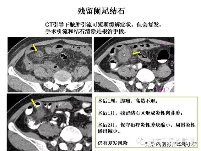 阑尾炎课件,阑尾炎的超声课件