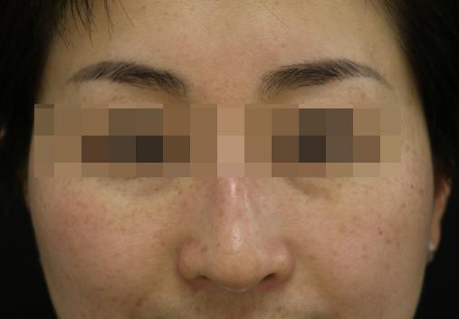 褐斑内调方法,褐斑的原因和治疗方法