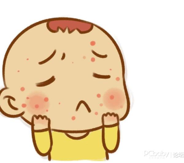 新生儿湿疹与热疹的区别,新生儿湿疹的症状