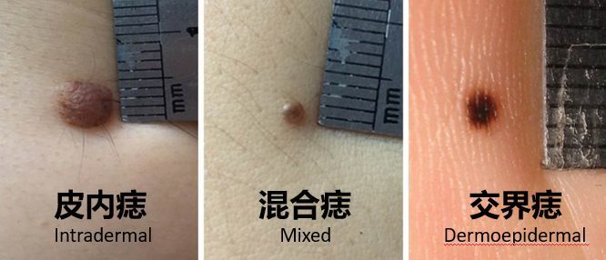 黑色素痣癌变的前兆切除能治愈吗,激光点黑色素痣能诱发恶变吗