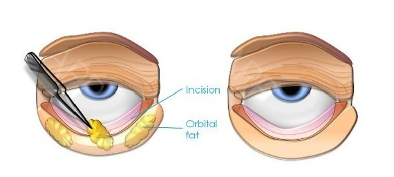 黑三角面相,黑三角如何维护