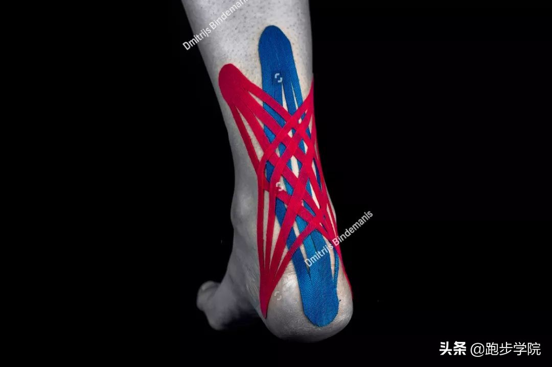 跟腱炎发病处理,跟腱炎如何治疗才能恢复