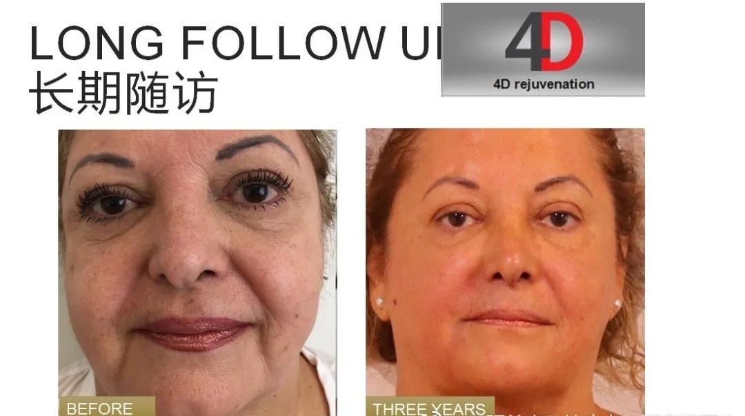 fotona4d有效果吗,fotona4d做完前后对比