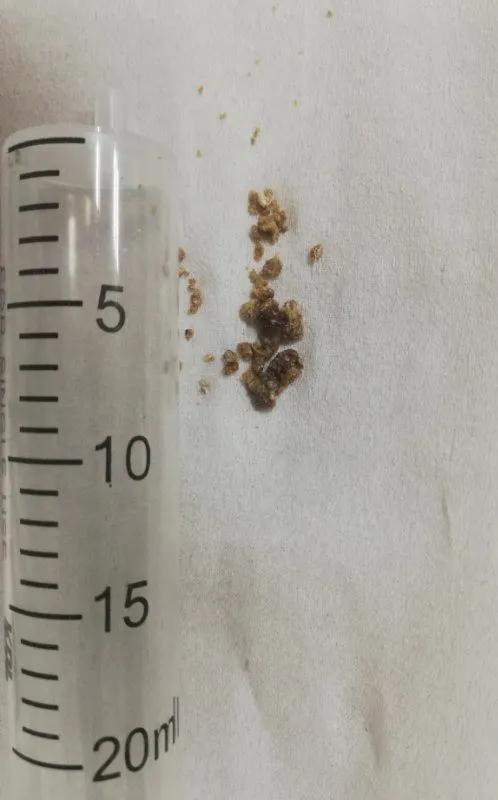 经皮肾镜切开取石术,超微可视经皮肾镜碎石取石术危险