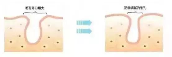 毛孔粗大收缩毛孔最有效的方法,毛孔粗大收缩毛孔最快有效的方法