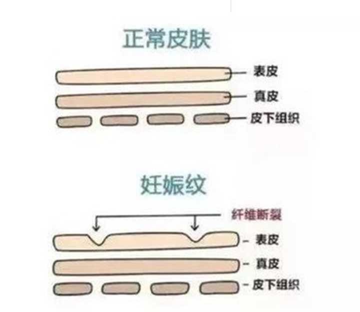 袋鼠妈妈橄榄油可以预防妊娠纹吗,橄榄油预防妊娠纹都有哪些牌子