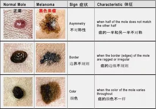 癌变的黑色痣是后期长出来的吗,黑痣癌变会有什么反应