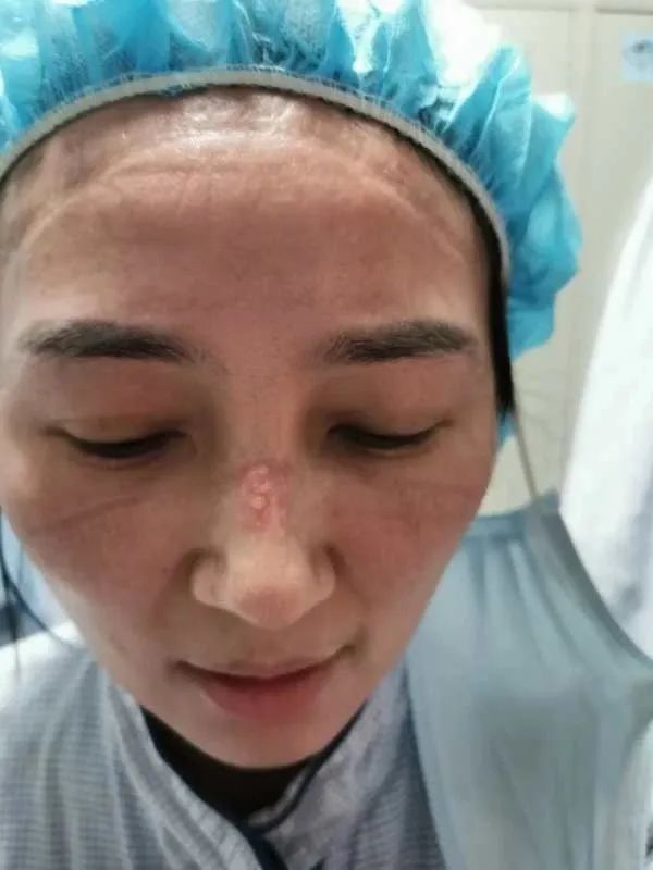 长时间戴口罩皮肤发红怎么办,戴口罩脸部有压痕怎么办