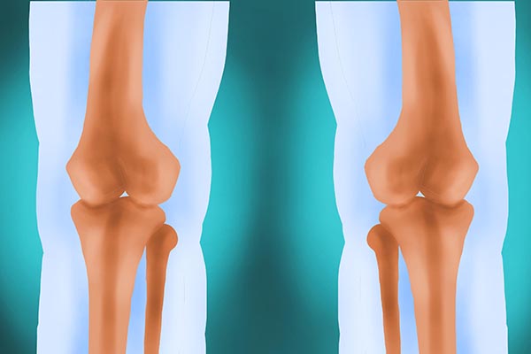 运动时肩膀关节咔咔响怎么回事,运动中膝盖关节咔咔响是什么原因