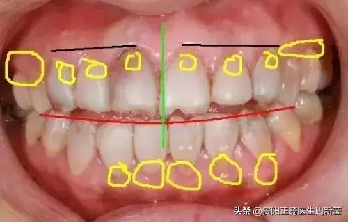 烤瓷牙做过后最好的修复方法,烤瓷牙里面的真牙烂了怎么办