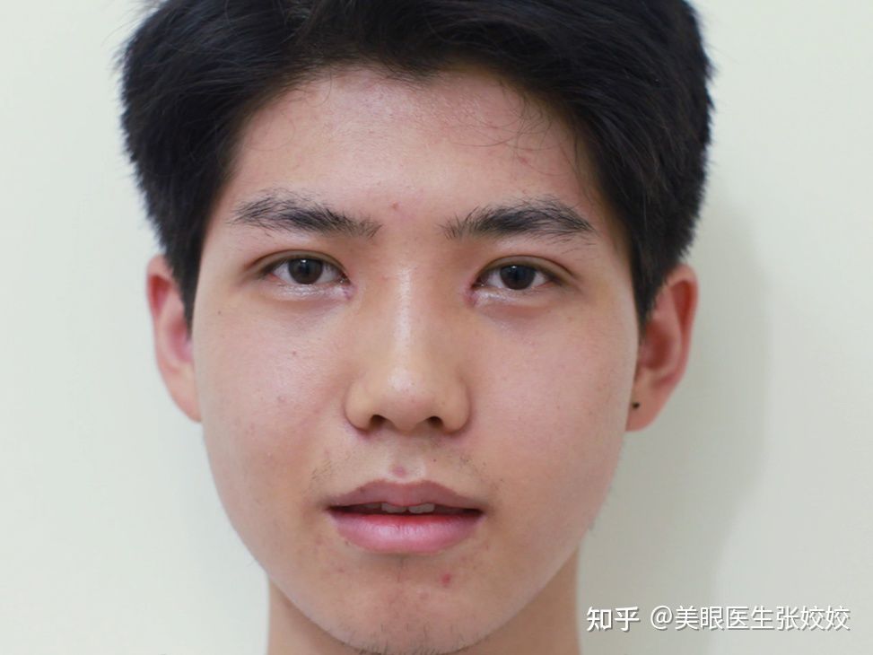 男生双眼皮手术前后对比,男生做双眼皮手术的效果