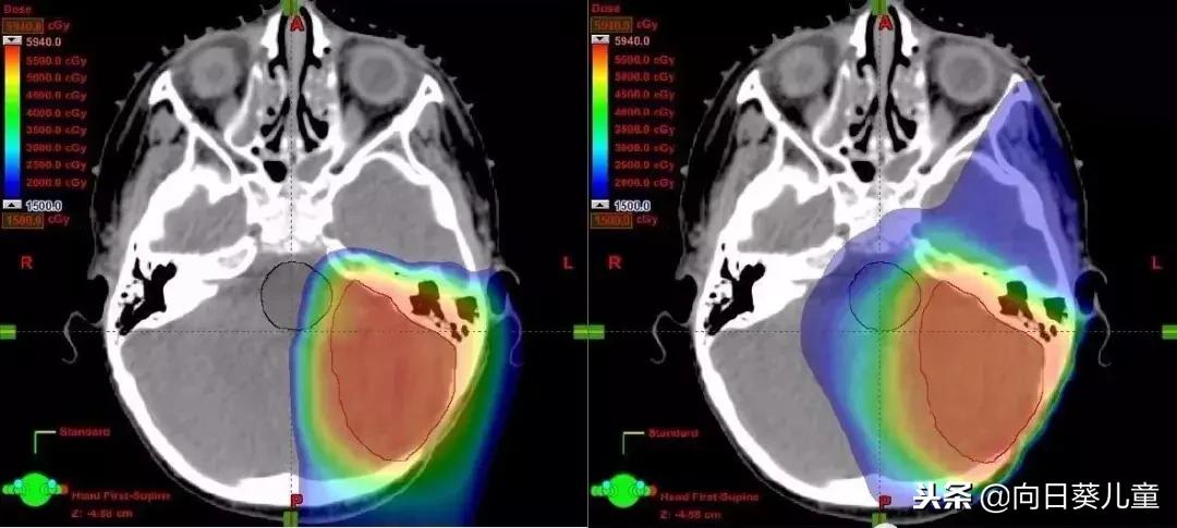 质子治肿瘤怎么样,儿童肿瘤质子治疗好吗