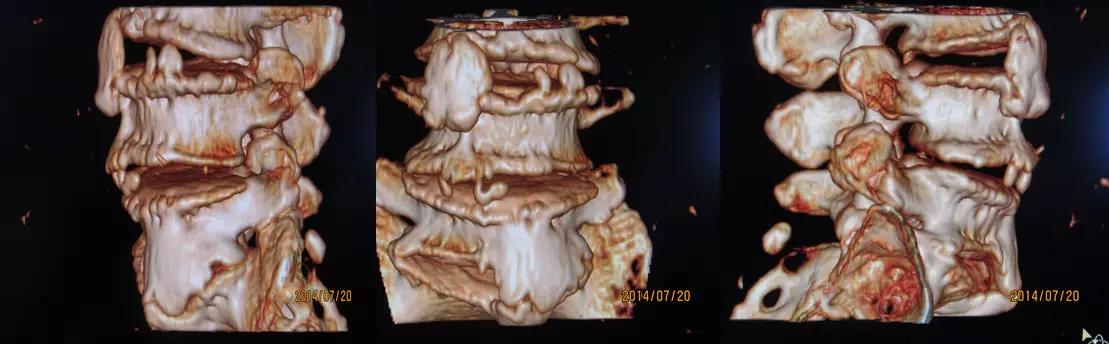 颈椎腰椎疾病ct及mri诊断,腰椎ct可以发现肠部病变吗
