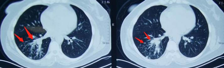 26岁确诊肺癌,26岁得了肺结核