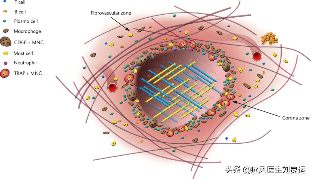 痛风富贵病,饮食很清淡但犯痛风了