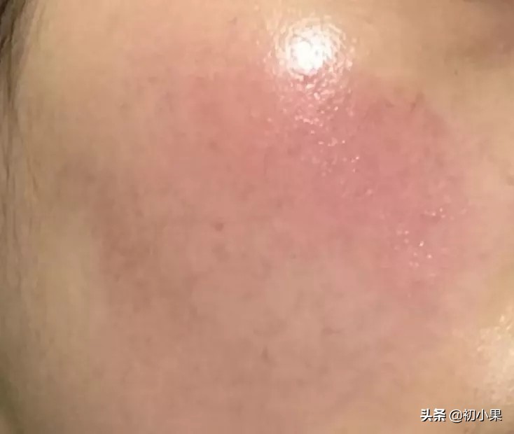 皮肤油是因为缺水吗,皮肤油是不是缺水