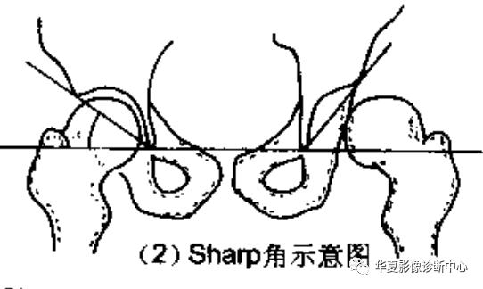 先天性髋关节脱位饮食,先天性髋关节脱位属不属于残疾人
