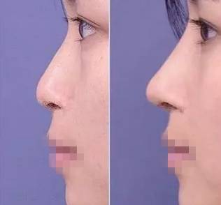 明星注射玻尿酸案例,注射玻尿酸变美