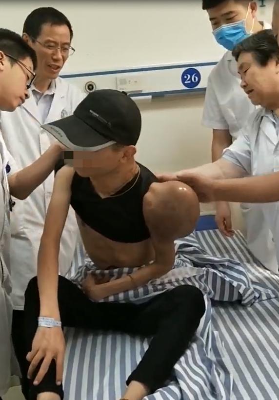 梭形细胞瘤长得特别快是不是恶性,梭形细胞瘤亲身经历