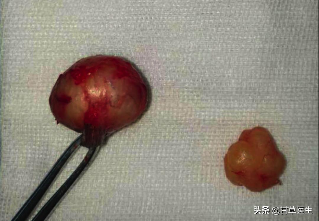 发现硬块是什么原因,发现包块是癌症晚期吗