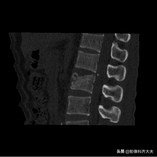 骨折的影像学检查及各自的优势,骨折的影像学愈合标准
