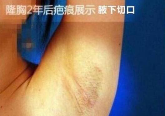 关于假体丰胸的问题,假体隆胸的5个问题