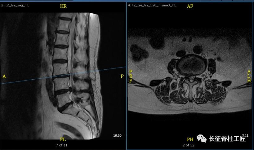老年人腰椎管狭窄可以微创手术吗,老年人腰椎管狭窄瘫痪