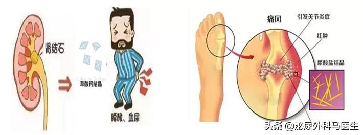 尿液里会有固体吗,尿液里会有沉淀物吗