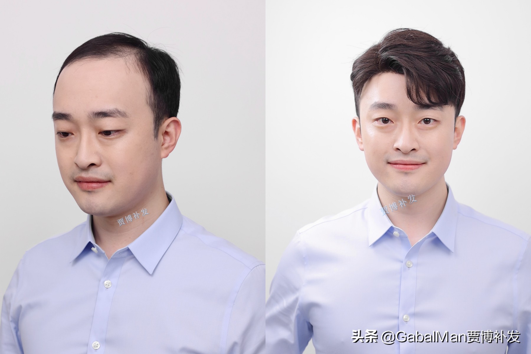 60分钟拯救你的秃头形象,发际线高拯救视频