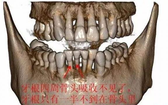 什么叫牙槽骨流失,牙槽骨吸收牙根露出来怎么办